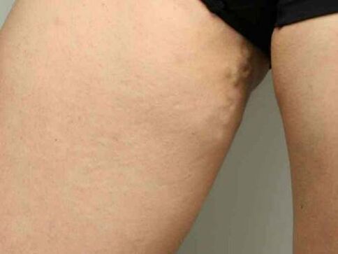 żylaki miednicy w czasie ciąży